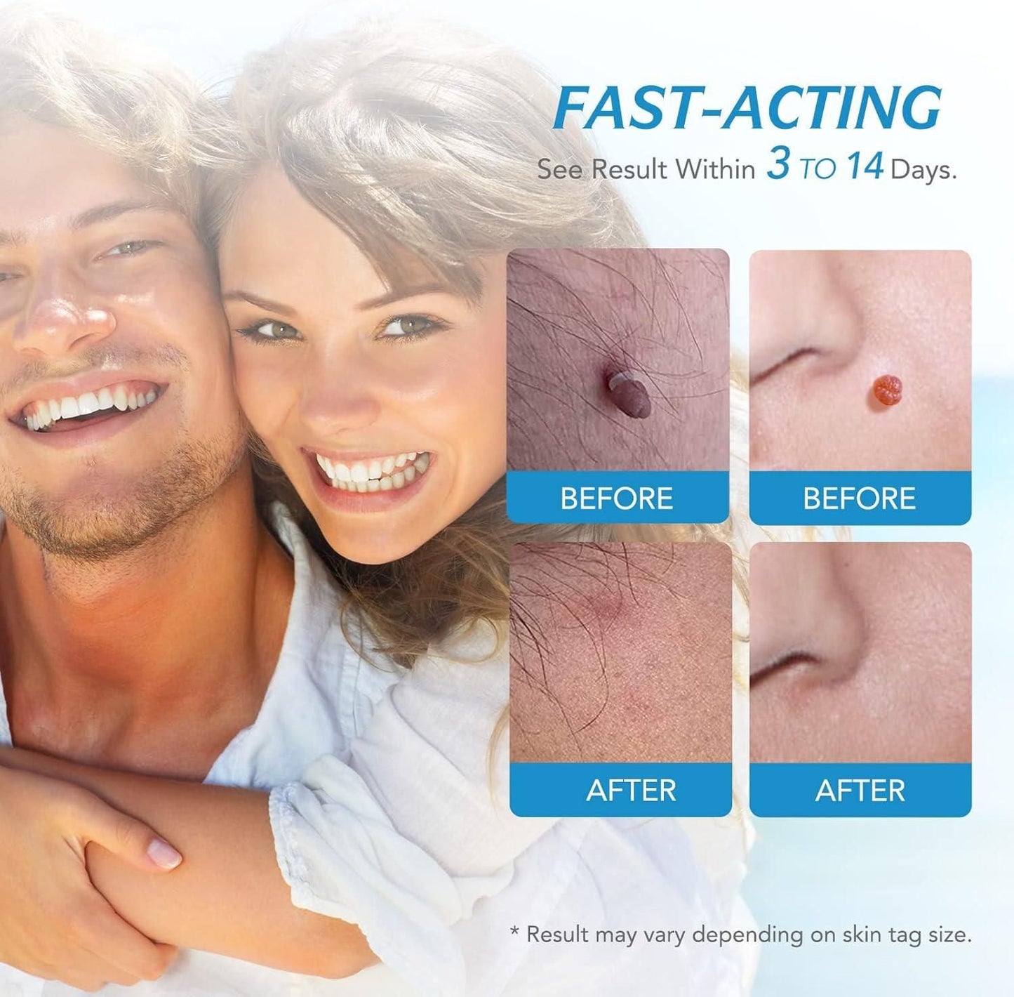 2-in-1 Skin Tag Remover Kit – Painless & Safe for All Skin Types - Catalyst Mart
