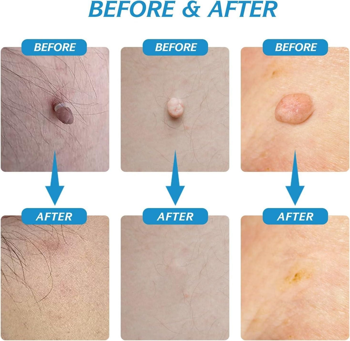 2-in-1 Skin Tag Remover Kit – Painless & Safe for All Skin Types - Catalyst Mart