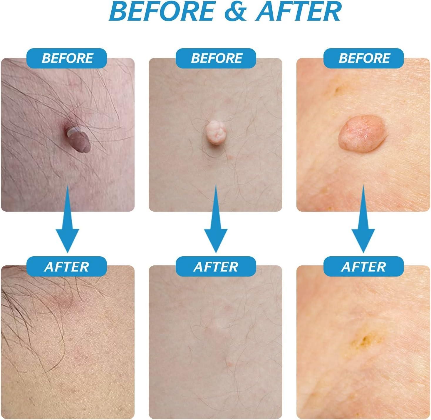 2-in-1 Skin Tag Remover Kit – Painless & Safe for All Skin Types - Catalyst Mart